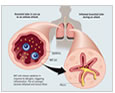 enfermedad pulmonar obstructiva cronica