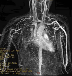vasculitis pulmonar