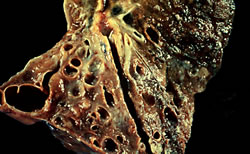 fibrosis quistica